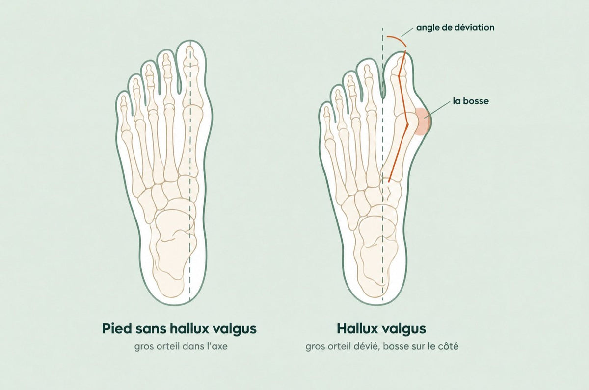 Hallux valgus : pourquoi la bosse apparaît, et ce que vous pouvez faire au quotidien